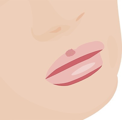 EPS 해외이미지 여자 얼굴 백그라운드 일러스트 건강 사람 치료 약 고통 추위 흰색 열 입 조직 바이러스 질병 입술 감염 전염 문제 알레르기 고립 돌봄 염증 증상 해외202004 구내염 해외일러스트 감정 컬러 의학 모션 신체부위 파일형식 벡터 이미지허브