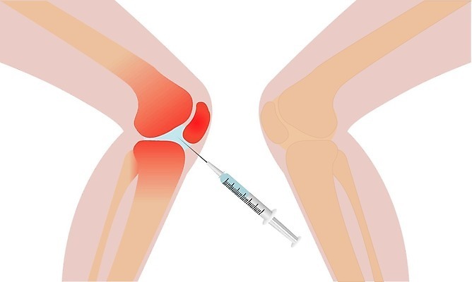 EPS 해외이미지 과학 일러스트 해부 건강 주사기 사람 내부 치료 약 손상 고통 의사 대접 수술 사건 무릎 문제 주사약 외과 테라피 순서 돌봄 연골 염증 정형외과 증상 헬프 해외202004 해외일러스트 감정 컨셉 의학 의료기기 모션 병원 신체부위 뷰티 의료진 도움 질병 파일형식 벡터 이미지허브