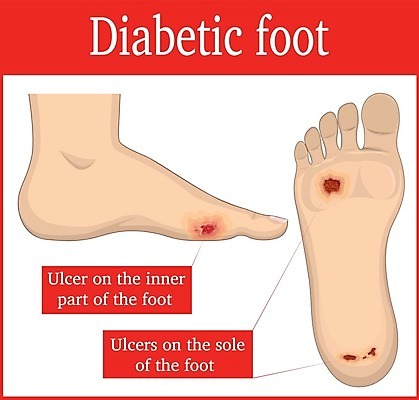 EPS 해외이미지 신체 일러스트 해부 맨발 발 실내 내부 빨간색 약 고통 의사 점 질병 상처 피부 지역 문제 테라피 연소 고립 당뇨병 양발 염증 치유 유일 해외202004 해외일러스트 감정 컬러 의학 신체부위 뷰티 의료진 파일형식 벡터 이미지허브