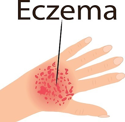 EPS 해외이미지 손 백그라운드 신체 일러스트 건강 사람 빨간색 약 고통 환자 짜증 흰색 점 질병 피부 감염 문제 스킨케어 테라피 알레르기 두드러기 고립 돌봄 염증 해외202004 해외일러스트 감정 컬러 의학 모션 신체부위 뷰티 파일형식 벡터 이미지허브