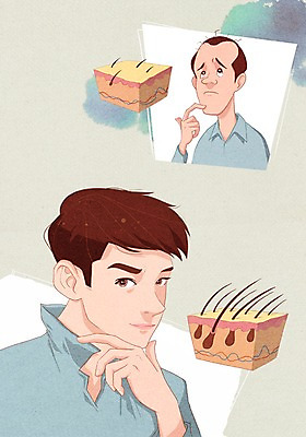 PSD 남자 일러스트 성공 사람 두명 뷰티 머리카락 비교 변화 성형수술 만족 두피 모발이식 남자만 그루밍족 모낭 국내일러스트 감정 컨셉 머리 수술 파일형식