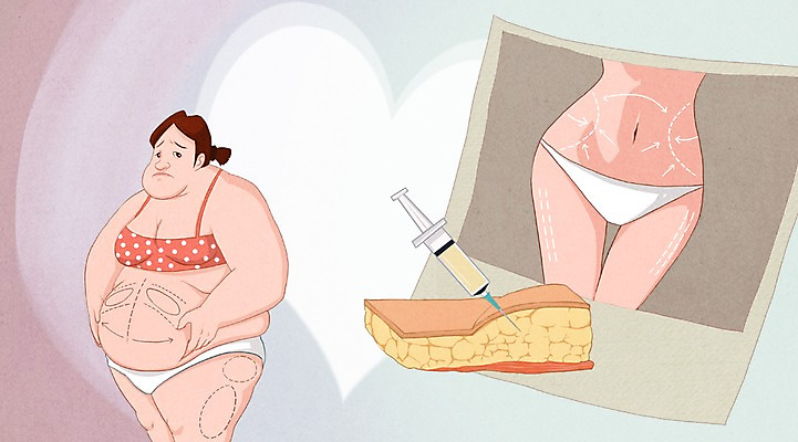 PSD 여자 일러스트 성공 주사기 한명 사람 성인 뷰티 비교 변화 성형수술 속옷 지방 몸매 비만 날씬함 만족 기념사진 지방흡입 여자만 여자한명만 성인여자만 성인만 국내일러스트 1 옷 감정 컨셉 의료기기 수술 기름_음식 파일형식