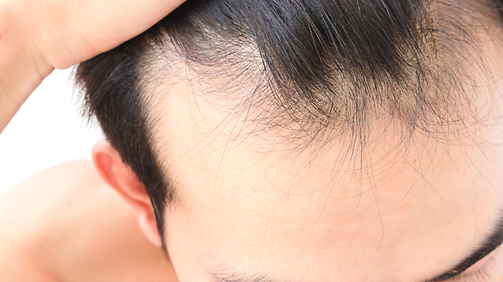 포토 JPG 해외이미지 남자 한명 성인 뷰티 머리카락 머리 흰배경 두피관리 두피케어 탈모 탈모클리닉 성인남자한명만 해외202004 탈모예방 해외포토 1 백그라운드 사람 신체부위 흰색 예방 클리닉 헤어관리 증상 남자한명만 성인남자만 파일형식 이미지허브