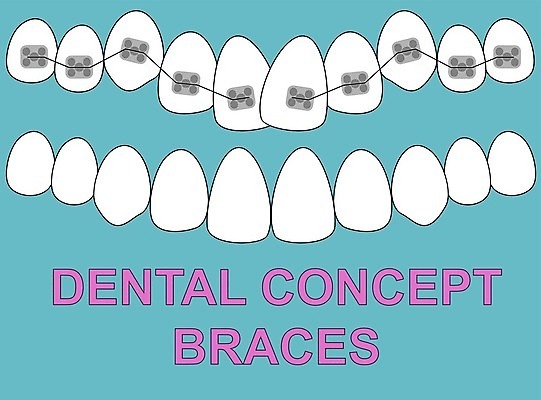 EPS 해외이미지 모델 디자인 배너 백그라운드 컨셉 일러스트 건강 치과 병원 약 우주 금속 장비 흰색 입 틈 비교 치아 보호 만화 심볼 사인 치과의사 심플 철사 문제 틀니 돌봄 위생관리 잇몸 증상 치아교정 해로움 해외202004 해외일러스트 컬러 신체 의학 모션 재질 관리 신체부위 의사 소화기관 교정 파일형식 벡터 이미지허브