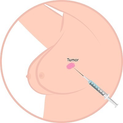EPS 해외이미지 여자 교육 캠페인 분홍색 컨셉 신체 일러스트 해부 건강 안전 약 고통 시험 의사 짜증 질병 가슴 피부 예방 암 덩어리 해고 궤 그만 돌봄 셀프 종양 증상 헬프 해외202004 해외일러스트 감정 컬러 비즈니스 의학 모션 사람 신체부위 의료진 도움 파일형식 벡터 이미지허브