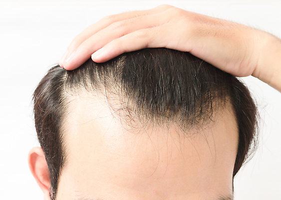 포토 JPG 해외이미지 남자 한명 근접촬영 상반신 성인 뷰티 머리카락 머리 잡기 흰배경 두피관리 두피케어 탈모 탈모클리닉 성인남자한명만 해외202004 탈모예방 해외포토 1 뷰포인트 백그라운드 모션 사람 신체부위 흰색 예방 클리닉 헤어관리 증상 남자한명만 성인남자만 파일형식 이미지허브