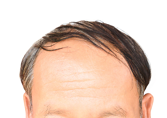 포토 JPG 해외이미지 남자 한명 상반신 성인 뷰티 머리카락 흰배경 두피관리 두피케어 탈모 탈모클리닉 성인남자한명만 해외202004 탈모예방 해외포토 1 백그라운드 사람 머리 흰색 예방 클리닉 헤어관리 증상 남자한명만 성인남자만 파일형식 이미지허브