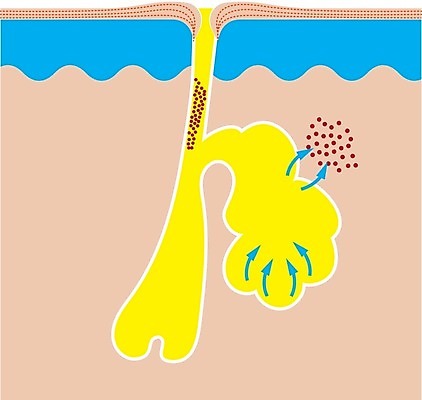 EPS 해외이미지 일러스트 해부 세포 건강 사람 치료 약 흰색 죽음 질병 피부 감염 박테리아 여드름 돌봄 염증 흉터 해외202004 해외일러스트 컬러 의학 모션 신체부위 상처 파일형식 벡터 이미지허브