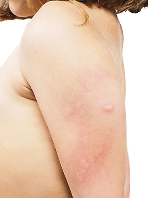 포토 JPG 해외이미지 여자 어린이 분홍색 곤충 건강 사람없음 빨간색 금발 갈색 손상 고통 뜨거움 바이러스 말벌 작음 사건 왼쪽 피부 어깨 감염 팔 찌르기 토막 벌집 알레르기 두드러기 모기 반응 백신 염증 제어 해로움 해외202004 해외포토 동물 헤어스타일 감정 컬러 컨셉 의학 모션 사람 신체부위 해충 벌_곤충 질병 크기 방향 파일형식 이미지허브