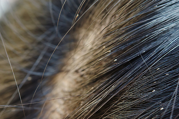 포토 JPG 해외이미지 동물 행복 얼굴 어린이 곤충 백그라운드 자연 건강 사람 사람없음 치료 갈색 머리 우주 닫기 감염 분무기 문제 샴푸 부화 기생충 돌봄 위생관리 해외202004 해외포토 감정 컬러 의학 모션 관리 신체부위 위생용품 바이러스 생태계 파일형식 이미지허브