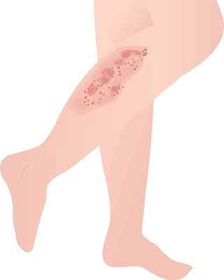 EPS 해외이미지 여자 남자 백그라운드 신체 일러스트 건조 건강 사람 치료 빨간색 약 건강관리 손상 고통 환자 흰색 질병 피부 감염 문제 스킨케어 알레르기 두드러기 고립 돌봄 면역력 양발 염증 못생김 해외202004 해외일러스트 감정 컬러 컨셉 의학 모션 관리 신체부위 뷰티 파일형식 벡터 이미지허브