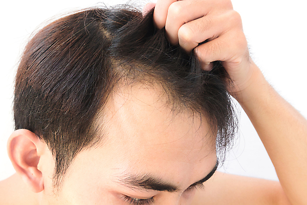 포토 JPG 해외이미지 남자 한명 성인 뷰티 머리카락 머리 잡기 흰배경 두피관리 두피케어 탈모 탈모클리닉 성인남자한명만 해외202004 탈모예방 해외포토 1 백그라운드 모션 사람 신체부위 흰색 예방 클리닉 헤어관리 증상 남자한명만 성인남자만 파일형식 이미지허브