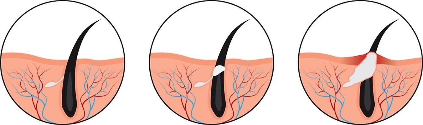 EPS 해외이미지 웰빙 응시 여자 얼굴 백그라운드 일러스트 해부 청소년 사람 치료 10대 빨간색 건강관리 화장품 성장 짜증 흰색 얼룩 폭발 피부 피부관리 감염 문제 여드름 순서 고립 돌봄 사춘기 염증 위생관리 흉터 해외202004 해외일러스트 시선 감정 컬러 의학 모션 건강 관리 신체부위 뷰티 질병 상처 파일형식 벡터 이미지허브