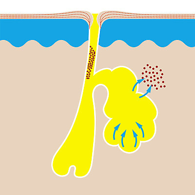 포토 JPG 해외이미지 해부 세포 건강 사람 사람없음 치료 약 흰색 죽음 질병 피부 감염 박테리아 여드름 돌봄 염증 흉터 해외202004 해외포토 컬러 의학 모션 신체부위 상처 파일형식 이미지허브