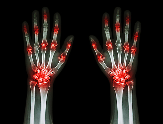 포토 JPG 해외이미지 손 신체 손가락 해부 뼈 골격 엑스레이 건강 병원 손바닥 사람 사람없음 빨간색 파란색 숫자 약 고통 환자 의사 광선 질병 X 손목 관절염 외과 고립 돌봄 방사선 염증 정형외과 해외202004 해외포토 문자 알파벳 감정 컬러 의학 모션 신체부위 의료진 파일형식 이미지허브