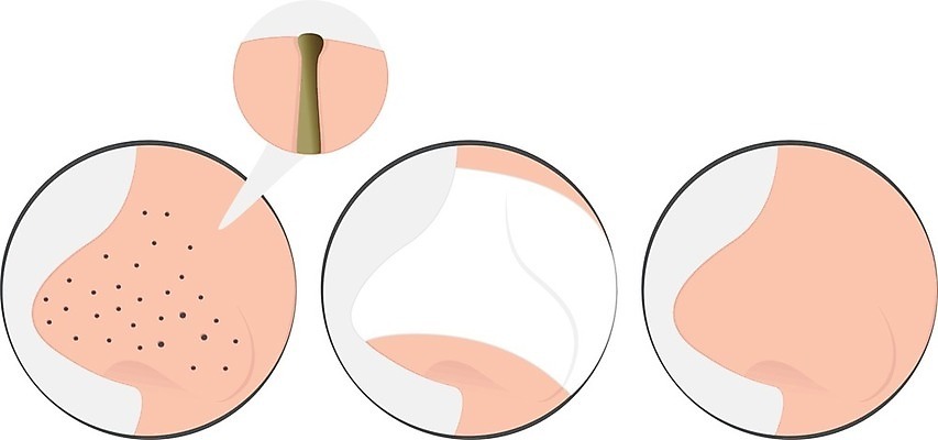 EPS 해외이미지 얼굴 일러스트 건강 가면 치료 검은색 스파 화장품 점 오픈 질병 피부 크림 피부관리 코 문제 여드름 돌봄 사춘기 염증 위생관리 트러블 전후 해외202004 해외일러스트 컬러 의학 모션 관리 신체부위 뷰티 비교 파일형식 벡터 이미지허브