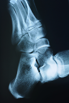 포토 JPG 해외이미지 해부 엑스레이 사람 사람없음 옆모습 신체부위 걷기 건강관리 고통 질병 관절염 발목 빛망울 골절 해외202004 해외포토 감정 뷰포인트 의학 모션 발 건강 관리 빛 파일형식 이미지허브