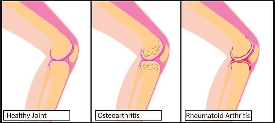 EPS 해외이미지 과학 신체 일러스트 손가락 해부 근육 뼈 골격 건강 종류 사람 약 고통 거친 질병 관절염 무릎 골다공증 테라피 타입 돌봄 면역력 연골 염증 지원 해외202004 해외일러스트 손 감정 의학 모션 신체부위 뷰티 파일형식 벡터 이미지허브