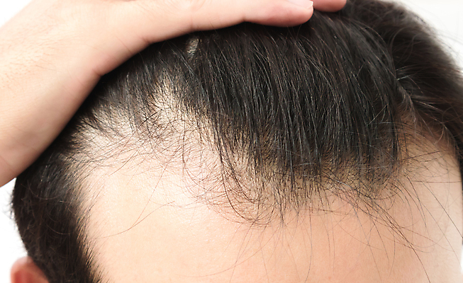 포토 JPG 해외이미지 남자 한명 근접촬영 성인 뷰티 머리카락 머리 흰배경 두피관리 두피케어 탈모 탈모클리닉 성인남자한명만 해외202004 탈모예방 해외포토 1 뷰포인트 백그라운드 사람 신체부위 흰색 예방 클리닉 헤어관리 증상 남자한명만 성인남자만 파일형식 이미지허브