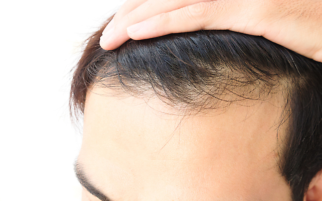 포토 JPG 해외이미지 남자 한명 근접촬영 성인 뷰티 머리카락 머리 잡기 흰배경 두피관리 두피케어 탈모 탈모클리닉 성인남자한명만 해외202004 탈모예방 해외포토 1 뷰포인트 백그라운드 모션 사람 신체부위 흰색 예방 클리닉 헤어관리 증상 남자한명만 성인남자만 파일형식 이미지허브