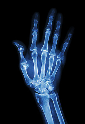 포토 JPG 해외이미지 손 백그라운드 손가락 해부 뼈 골격 엑스레이 건강 병원 손바닥 사람 사람없음 파란색 약 검은색 고통 환자 의사 광선 수술 질병 X 사건 손목 필름 팔 외과 고립 골절 깨짐 방사선 정형외과 많음 해외202004 해외포토 알파벳 감정 컬러 컨셉 의학 신체부위 치료 의료진 파일형식 이미지허브
