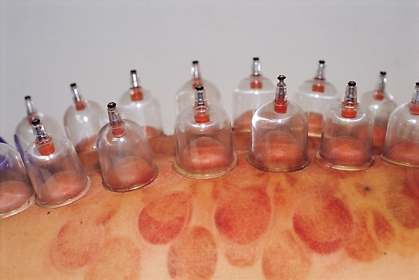 포토 JPG 의학 실내 사람 신체부위 치료 한의학 의료용품 한의원 부항 부항단지 국내포토 의료기기 병원 내부 파일형식