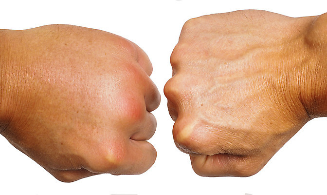 포토 JPG 해외이미지 백인 손 남자 곤충 백그라운드 손가락 건강 관리 사람 사람없음 주먹 손상 고통 흰색 비교 벌레 말벌 질병 사건 피부 보여주기 찌르기 토막 알레르기 고립 돌봄 모기 못생김 해외202004 해외포토 서양인 동물 감정 컬러 컨셉 의학 모션 신체부위 해충 벌_곤충 파일형식 이미지허브