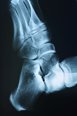 포토 JPG 해외이미지 해부 엑스레이 사람 사람없음 옆모습 신체부위 걷기 건강관리 고통 질병 관절염 발목 빛망울 골절 해외202004 해외포토 감정 뷰포인트 의학 모션 발 건강 관리 빛 파일형식 이미지허브