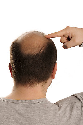 포토 JPG 해외이미지 백인 헤어스타일 남자 얼굴 부분 수염 건강 한명 사람 성인 치료 약 갈색 머리 활발 흰색 머리빗 점 중앙 질병 정상 자르기 피부 대머리 고립 돌봄 방법 적자 스타일 해외202004 해외포토 서양인 1 컬러 컨셉 의학 모션 신체부위 미용용품 파일형식 이미지허브