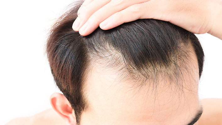 포토 JPG 해외이미지 남자 한명 근접촬영 성인 뷰티 머리카락 머리 흰배경 헤어관리 감싸기 두피관리 두피케어 탈모 탈모클리닉 성인남자한명만 해외202004 탈모예방 해외포토 1 뷰포인트 백그라운드 모션 사람 신체부위 흰색 예방 클리닉 증상 남자한명만 성인남자만 파일형식 이미지허브