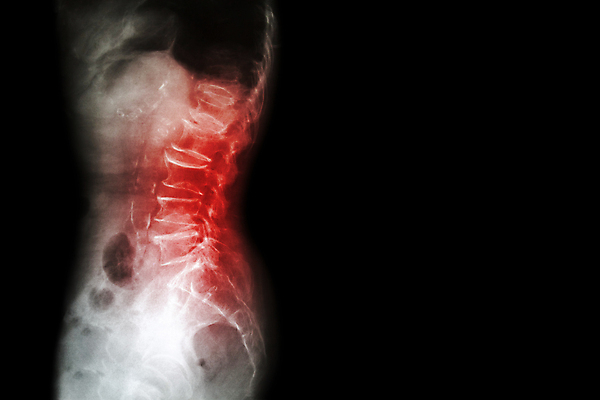 포토 JPG 해외이미지 백그라운드 신체 뼈 골격 엑스레이 건강 병원 사람없음 옆모습 빨간색 검은색 공백 고통 환자 광선 흰색 질병 X 허리 척추 관절염 골다공증 외과 고립 돌봄 방사선 염증 정형외과 해외202004 해외포토 알파벳 감정 뷰포인트 컬러 의학 모션 신체부위 파일형식 이미지허브