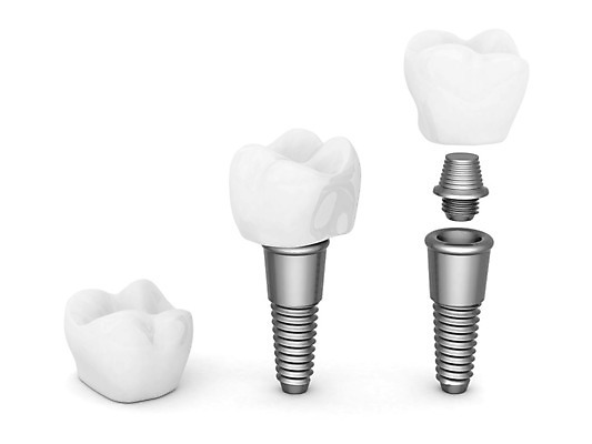 포토 JPG 해외이미지 모델 디자인 일러스트 건강 치과 사람없음 옆모습 치료 약 금속 흰색 입 치아 오브젝트 치과의사 뿌리 외과 틀니 고립 돌봄 인공 철강 티타늄 해외202004 해외포토 뷰포인트 컬러 의학 모션 재질 병원 신체부위 의사 소화기관 원소 파일형식 이미지허브