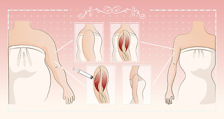 여자 일러스트 주사기 여러명 성인 뷰티 성형수술 몸매 보톡스 팔뚝 국내일러스트 AI파일 다수 의료기기 사람 신체부위 수술 파일형식 벡터