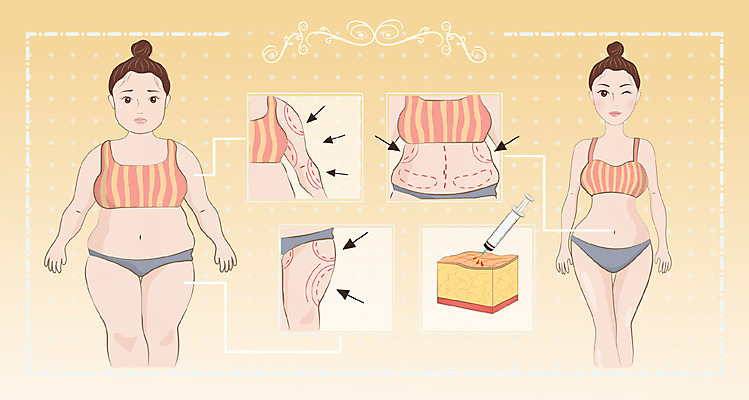 여자 일러스트 주사기 성인 두명 뷰티 성형수술 몸매 지방제거 국내일러스트 AI파일 의료기기 사람 수술 파일형식 벡터
