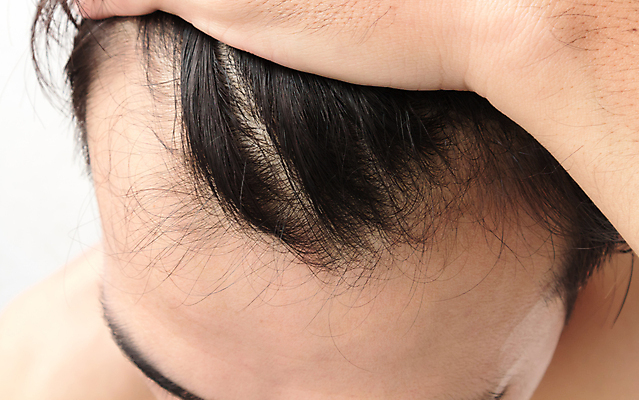 포토 JPG 해외이미지 남자 한명 근접촬영 성인 뷰티 머리카락 머리 흰배경 헤어관리 두피관리 두피케어 탈모 탈모클리닉 성인남자한명만 해외202004 탈모예방 해외포토 1 뷰포인트 백그라운드 사람 신체부위 흰색 예방 클리닉 증상 남자한명만 성인남자만 파일형식 이미지허브