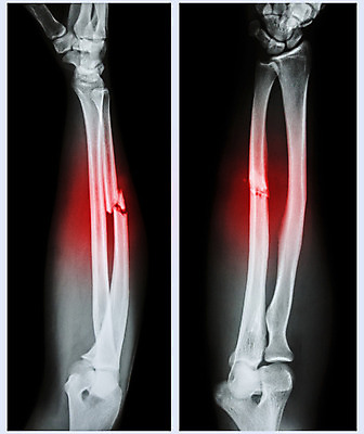 포토 JPG 해외이미지 손 신체 해부 뼈 골격 엑스레이 건강 병원 사람 사람없음 빨간색 검은색 고통 환자 의사 광선 흰색 긴급 질병 X 사건 손목 팔 외과 고립 골절 깨짐 돌봄 방사선 염증 정형외과 팔꿈치 해외202004 해외포토 알파벳 감정 컬러 컨셉 의학 모션 신체부위 의료진 파일형식 이미지허브