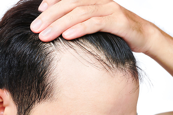 포토 JPG 해외이미지 남자 한명 근접촬영 성인 뷰티 머리카락 머리 흰배경 헤어관리 감싸기 두피관리 두피케어 탈모 탈모클리닉 성인남자한명만 해외202004 탈모예방 해외포토 1 뷰포인트 백그라운드 모션 사람 신체부위 흰색 예방 클리닉 증상 남자한명만 성인남자만 파일형식 이미지허브