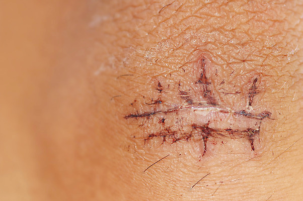 포토 JPG 해외이미지 육류 사람없음 치료 고통 환자 수술 질병 상처 자르기 사건 피부 눈물 땀 외과 바늘땀 절개 치유 팔꿈치 회복 흉터 해외202004 해외포토 감정 컨셉 식재료 의학 모션 병원 신체부위 팔 파일형식 이미지허브