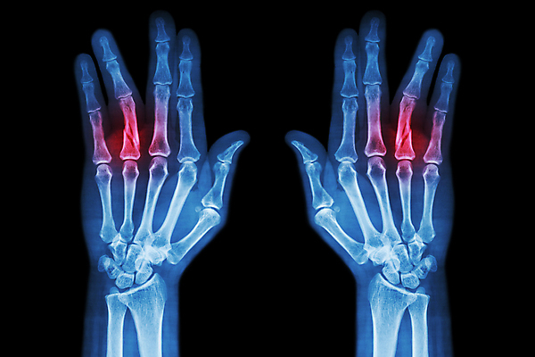 포토 JPG 해외이미지 손 곡선 손가락 해부 뼈 골격 엑스레이 건강 병원 숙이기 사람 사람없음 빨간색 파란색 숫자 검은색 고통 환자 의사 광선 긴급 반지 질병 X 사건 손목 필름 외과 고립 골절 깨짐 돌봄 방사선 염증 정형외과 해외202004 해외포토 문자 알파벳 감정 선 컬러 포즈 컨셉 장신구 의학 모션 신체부위 의료진 파일형식 이미지허브