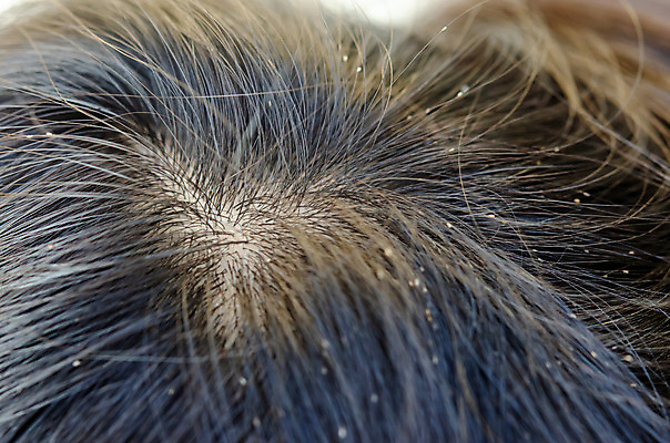 포토 JPG 해외이미지 동물 행복 얼굴 어린이 곤충 백그라운드 자연 건강 사람 사람없음 치료 갈색 머리 우주 닫기 감염 분무기 문제 샴푸 부화 기생충 돌봄 위생관리 해외202004 해외포토 감정 컬러 의학 모션 관리 신체부위 위생용품 바이러스 생태계 파일형식 이미지허브