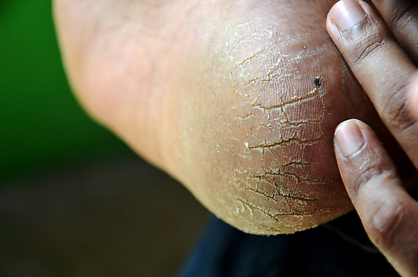 포토 JPG 해외이미지 여자 남자 백그라운드 신체 맨발 자연 건조 건강 사람 사람없음 치료 우주 손상 고통 흰색 균열 닫기 질병 피부 질감 감염 나쁜 곰팡이 돌봄 벌거벗은 양발 옛날 위생관리 페디큐어 해로움 못생김 해외202004 해외포토 감정 컬러 컨셉 의학 모션 발 관리 신체부위 뷰티 생태계 파일형식 이미지허브