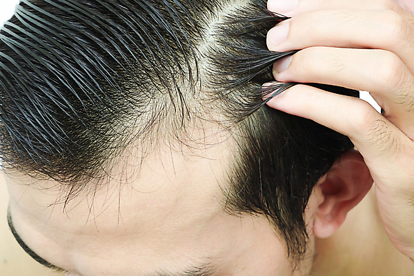 포토 JPG 해외이미지 손 남자 한명 성인 신체부위 뷰티 머리카락 머리 헤어관리 두피 두피관리 두피케어 탈모 탈모클리닉 성인남자한명만 해외202004 탈모예방 해외포토 1 사람 예방 클리닉 증상 남자한명만 성인남자만 파일형식 이미지허브