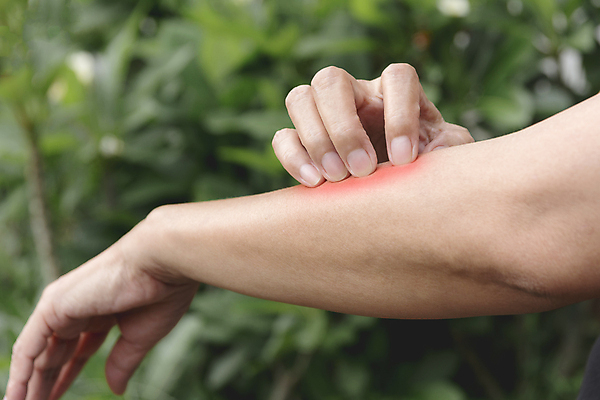 포토 JPG 해외이미지 손 여자 어린이 신체 건조 건강 사람 성인 사람없음 약 고통 질병 손목 피부 문제 팔 토막 알레르기 돌봄 모기 증상 해외202004 해외포토 감정 의학 모션 신체부위 해충 파일형식 이미지허브