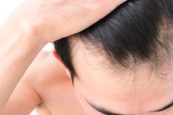 포토 JPG 해외이미지 남자 한명 근접촬영 상반신 성인 신체부위 뷰티 머리카락 머리 흰배경 헤어관리 감싸기 두피관리 두피케어 탈모 탈모클리닉 성인남자한명만 해외202004 탈모예방 해외포토 1 뷰포인트 백그라운드 모션 사람 흰색 예방 클리닉 증상 남자한명만 성인남자만 파일형식 이미지허브