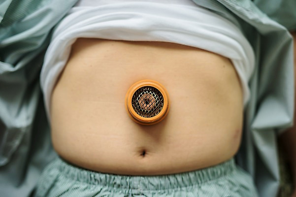 포토 JPG 노년 남자 실내 한명 앞모습 신체부위 치료 눕기 진료 한의학 한국인 환자 60대 한의원 뜸 진료실 복부 노인남자한명만 국내포토 1 뷰포인트 의학 모션 병원 사람 동양인 성인 내부 남자한명만 노인남자만 파일형식