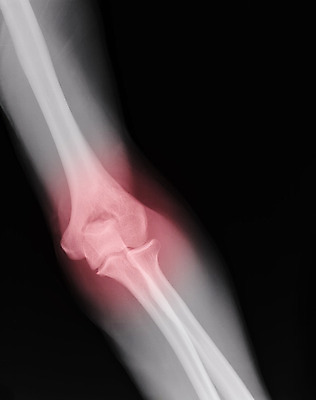 포토 JPG 해외이미지 남자 신체 해부 뼈 골격 엑스레이 건강 병원 사람 성인 사람없음 약 고통 환자 광선 수술 사건 필름 생물학 팔 외과 방사선 해외202004 해외포토 교육 감정 의학 신체부위 치료 파일형식 이미지허브