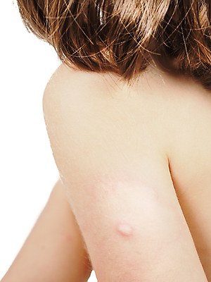 포토 JPG 해외이미지 여자 어린이 분홍색 곤충 건강 사람없음 빨간색 금발 갈색 손상 고통 뜨거움 바이러스 말벌 작음 사건 왼쪽 피부 어깨 감염 팔 찌르기 토막 벌집 알레르기 두드러기 모기 반응 백신 염증 제어 해로움 해외202004 해외포토 동물 헤어스타일 감정 컬러 컨셉 의학 모션 사람 신체부위 해충 벌_곤충 질병 크기 방향 파일형식 이미지허브