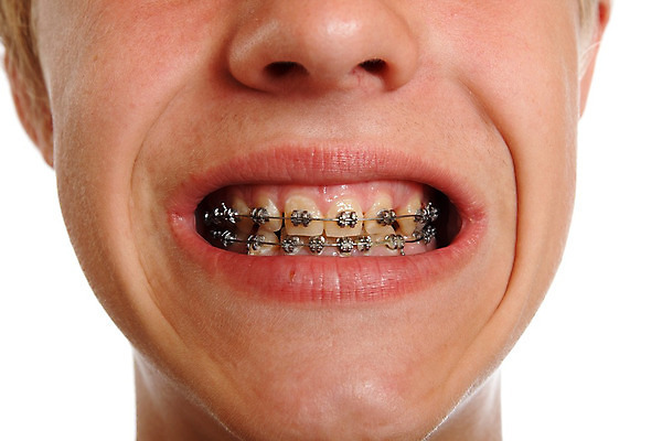 포토 JPG 해외이미지 치과 미소 신체부위 입 치아 교정기 위생관리 치아건강 치아교정 해외202004 해외포토 표정 건강 병원 관리 사람 소화기관 교정 파일형식 이미지허브