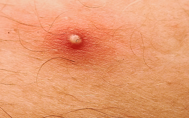 포토 JPG 해외이미지 백인 사람없음 10대 청춘 머리 금지 분노 흰색 점 피부 감염 충격 문제 덩어리 여드름 끓이기 돌봄 염증 이마 해외202004 해외포토 서양인 감정 컬러 컨셉 모션 청소년 신체부위 질병 파일형식 이미지허브