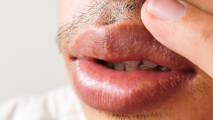 포토 JPG 해외이미지 백인 수염 건강 한명 사람 치료 약 고통 추위 열 입 바이러스 질병 피부 입술 사인 감염 문제 끓이기 유전 주목 해외202004 해외포토 서양인 1 감정 의학 모션 신체부위 파일형식 이미지허브